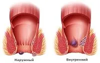 Як лікувати геморой у жінок? як лікувати геморой у жінок народними засобами
