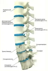 як лікувати остеохондроз крижового відділу