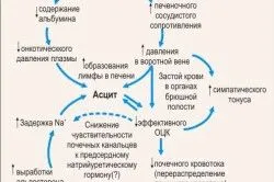як лікувати асцит печінки