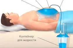 як лікувати асцит печінки