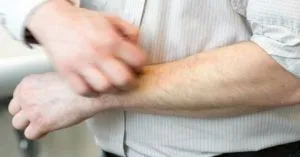 як вилікувати дерматит Дюрінга