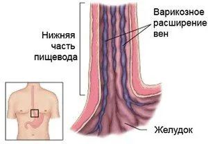 лікувати гастрит дієтою