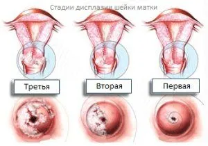 якщо не лікувати рак шийки матки
