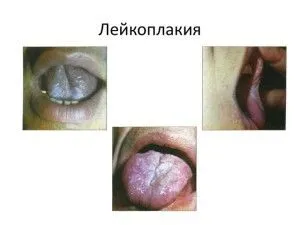 як лікувати лейкоплакію мови