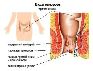 як лікувати розтягнення вен
