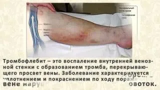 як лікувати варикоз дієта
