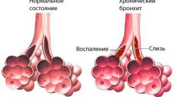 як лікувати хронічну мокроту