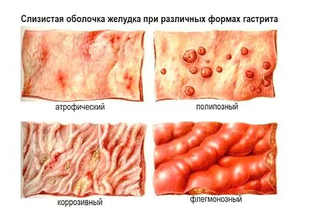 як лікувати гастрит у дорослих