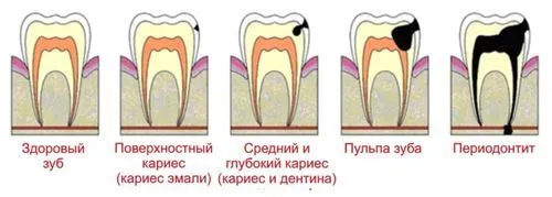 Лікувати карієс чи ні лікувати карієс чи ні