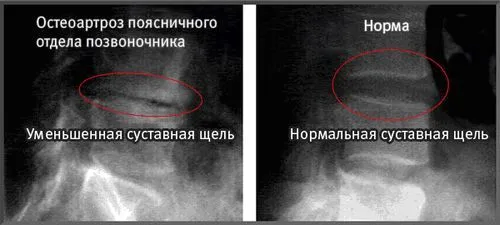 як лікувати артроз шийного хребця