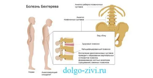 як вилікувати бронхіальну астму у дорослих