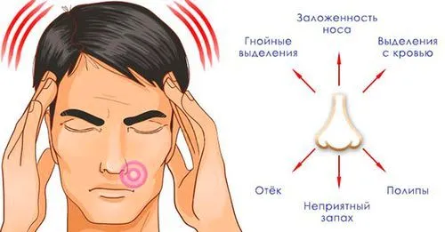 хронічний гайморит у дорослого
