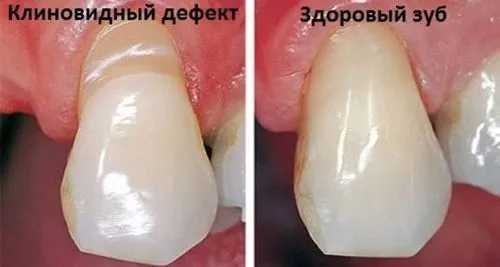 клиновидний дефект