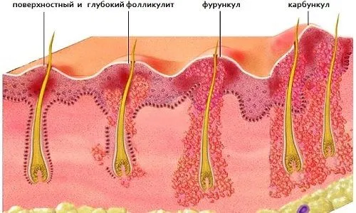 як лікувати фурункул в зоні бікіні