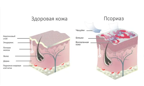 лікувати псоріаз содою