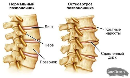 як лікувати артроз шийного хребця