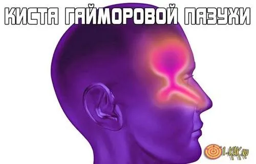 як лікувати кісту в гайморової пазухи