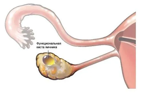 як лікувати функціональну кісту яєчника