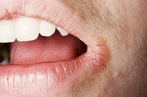 як лікувати заїди в куточках губ