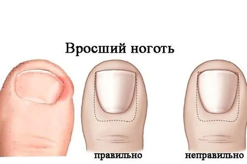 як лікувати врослі нігті