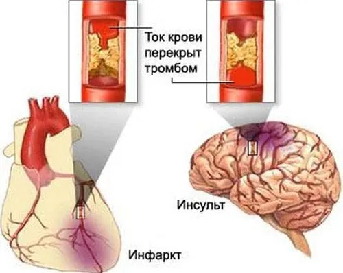 як лікувати міні інсульт