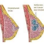 як лікувати фіброзну кісту