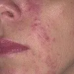 як лікувати розацеаподобний дерматит