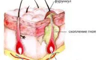 як лікувати фурункул під пахвою в домашніх умовах