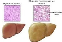 як лікувати дистрофію печінки