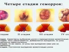 лікувати геморой реліф