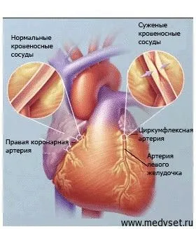 лікувати судини при цукровому діабеті