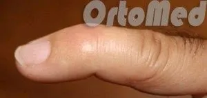 Сухожилля розгинача пальців кисті як лікувати забій вказівного пальця