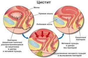 як вилікувати уретрит в домашніх умовах