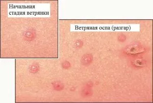 як лікувати прищі по всьому тілу