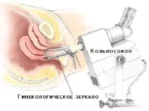 як лікувати рак шийки матки 3 ступеня