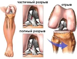 як лікувати травмований суглоб