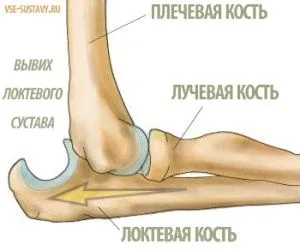 вивих ліктьового суглоба лікування симптоми