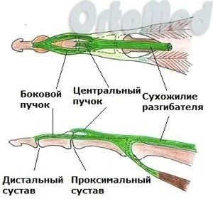 Сухожилля розгинача пальців кисті сухожилля розгинача пальців кисті зап'ястя пошкодження розрив