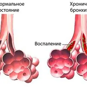 як лікувати гнійну мокроту