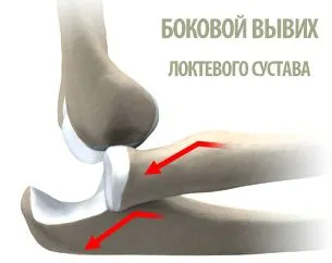 як лікувати розтягнення в лікті