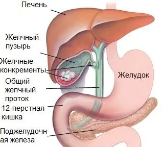 жовчнокам'яна хвороба