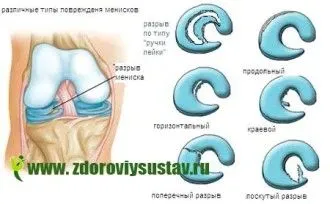 як лікувати розірваний меніск