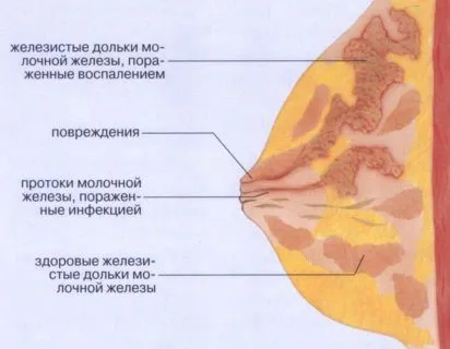 як краще лікувати мастит
