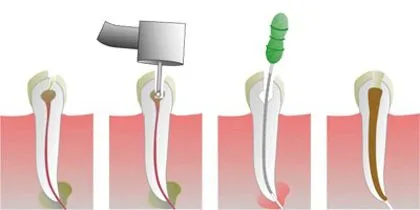 Чи є нерви в молочних зубах нерви лікувати треба