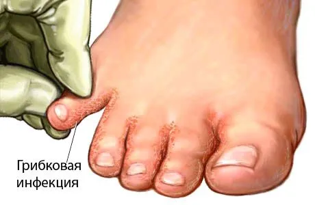 як вилікувати свербіж між ніг
