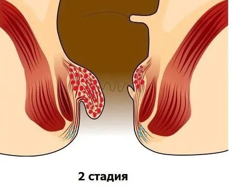 чи можна вилікувати геморой 2 стадії