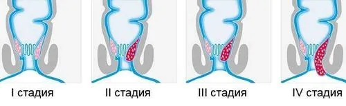 чи можна вилікувати геморой 2 стадії