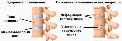 як лікувати хондроз куприка