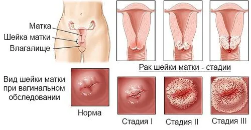 як лікувати рак шийки матки 3 ступеня