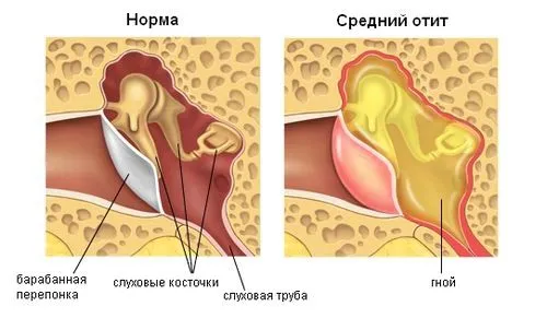 як лікувати гострий гнійний отит